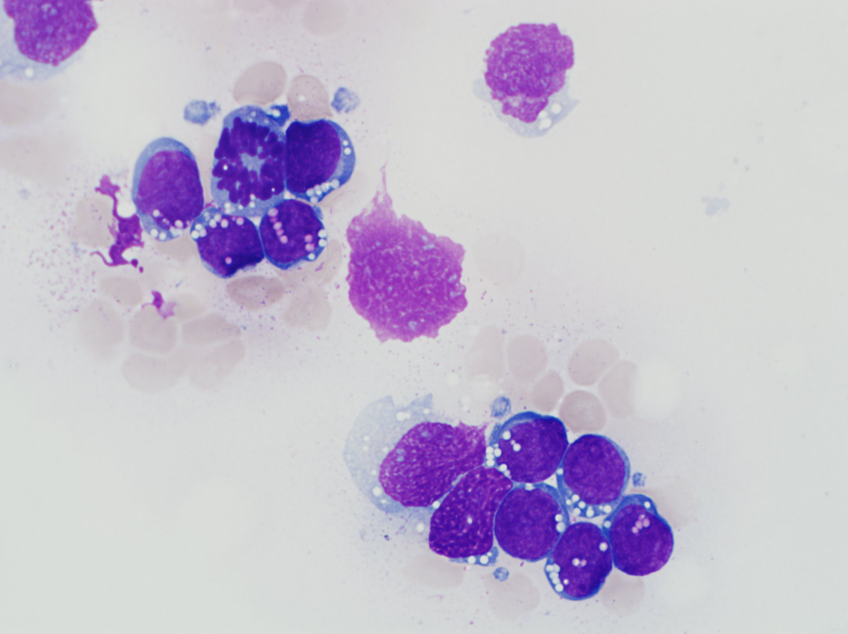 Bone marrow aspirate with Blasts showing Burkitt-like (ALL-L3 type) blasts.